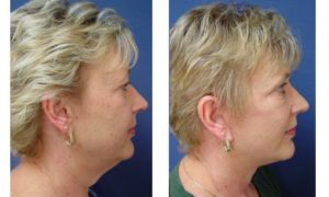 Rhinoplasty Plastic Surgeon Orange County