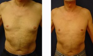 Male Breast Surgery Plastic Surgeon Orange County