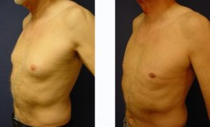 Male Breast Surgery Plastic Surgeon Orange County