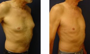 Male Breast Surgery Plastic Surgeon Orange County