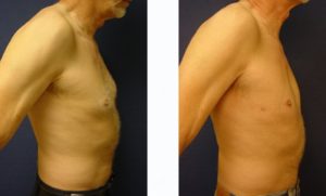 Male Breast Surgery Plastic Surgeon Orange County