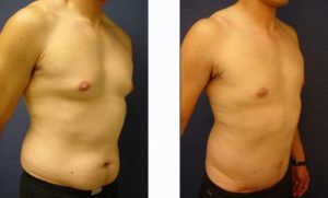 Male Breast Surgery Plastic Surgeon Orange County