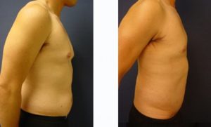 Male Breast Surgery Plastic Surgeon Orange County