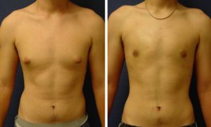 Male Breast Surgery Plastic Surgeon Orange County