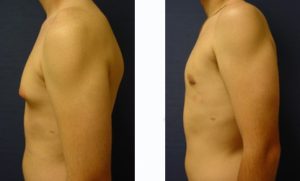 Male Breast Surgery Plastic Surgeon Orange County