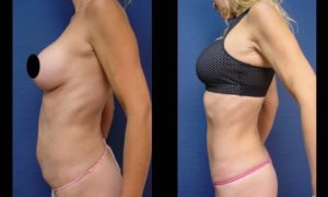 Tummy Tuck Plastic Surgeon Orange County