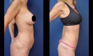 Tummy Tuck Plastic Surgeon Orange County