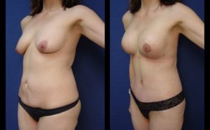 Mommy Makeover Plastic Surgeon Orange County