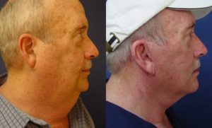 Neck Lift Plastic Surgeon Orange County