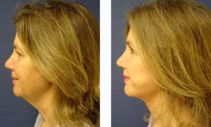 Neck Lift Plastic Surgeon Orange County