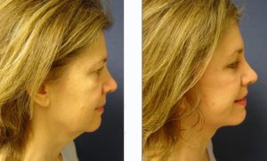 Neck Lift Plastic Surgeon Orange County