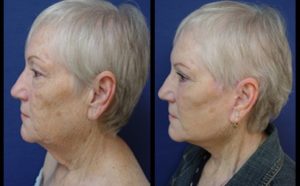 Neck Lift Plastic Surgeon Orange County