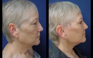 Neck Lift Plastic Surgeon Orange County