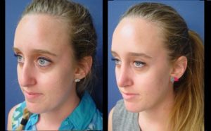 Rhinoplasty Plastic Surgeon Orange County