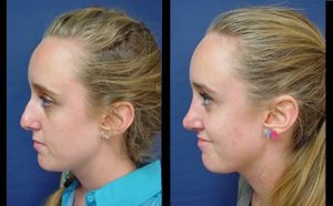 Rhinoplasty Plastic Surgeon Orange County