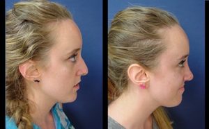 Rhinoplasty Plastic Surgeon Orange County