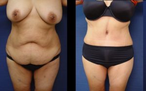 Tummy Tuck Plastic Surgeon Orange County