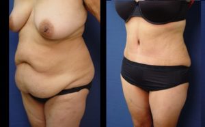 Tummy Tuck Plastic Surgeon Orange County