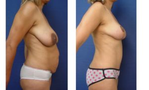 Tummy Tuck Plastic Surgeon Orange County