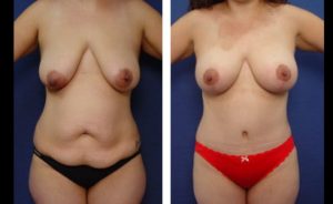 Tummy Tuck Patient Results Plastic Surgeon Orange County