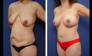 Tummy Tuck Patient Results Plastic Surgeon Orange County