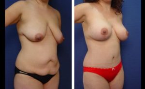 Tummy Tuck Patient Results Plastic Surgeon Orange County