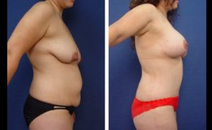 Tummy Tuck Patient Results Plastic Surgeon Orange County