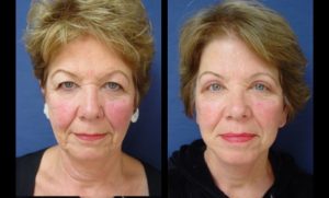 Upper Blepharoplasty Plastic Surgeon Orange County