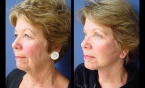 Upper Blepharoplasty Plastic Surgeon Orange County