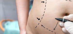 Tummy Tuck without drains