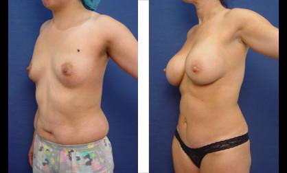 Tummy Tuck Newport Beach
