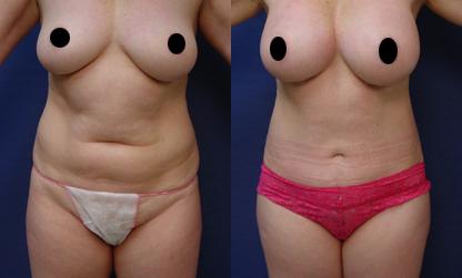 Plastic Surgery Orange County