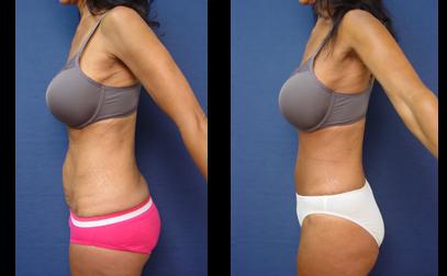 Tummy Tuck or Liposuction? Which Is Right for Your Muffin Top