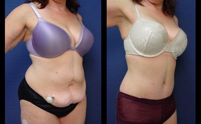 Tummy Tuck Orange County Plastic Surgeon