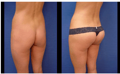 Butt Implant Results Orange County Plastic Surgeon