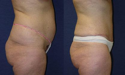 Tummy Tuck Newport Beach Plastic Surgeon