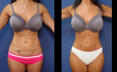 Before and after tummy tuck surgery