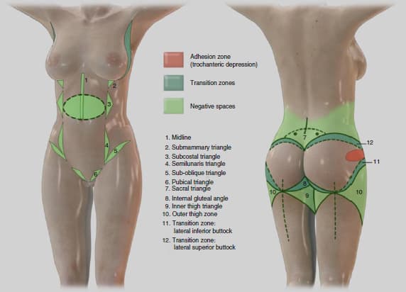 best VASER liposuction result technique