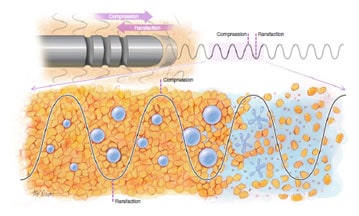 best VASER liposuction result technique