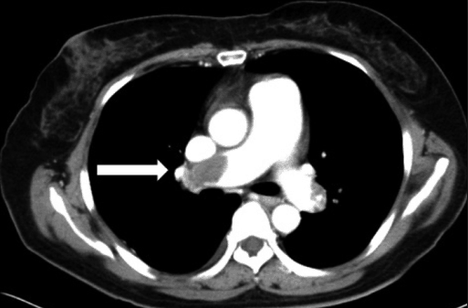 liposuction-brazilian-butt-lift-ct-scan-pulmonary-emboli-fat-embolism. 