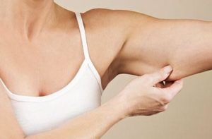 The Scarless Arm Lift, Plastic Surgery Orange County