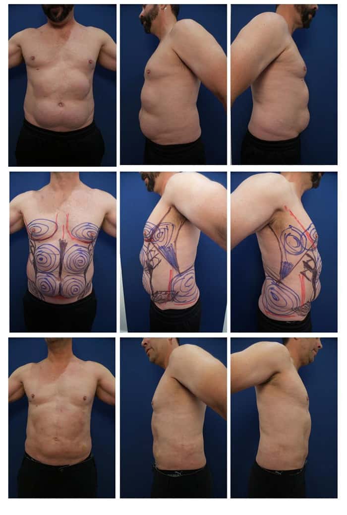 coolsculpting-paradoxical-adipose-hyperplasia-treatment