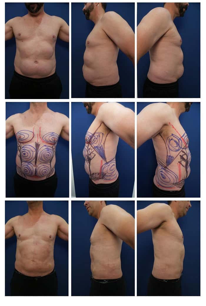 CoolSculpting PAH: The Paradoxical Adipose Hyperplasia Side Effect