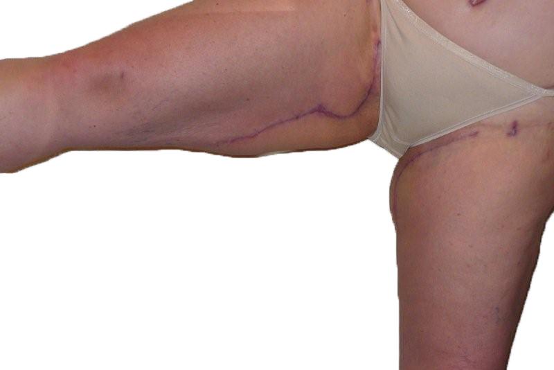 What will my Thigh Lift scar look like?