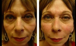 Facial fillers Before and After