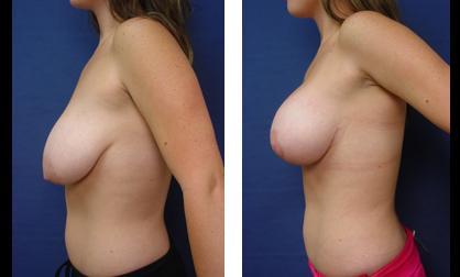 breast lift procedure