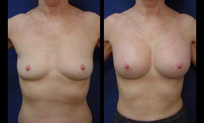 drlaguna-breast-implant-high-profile