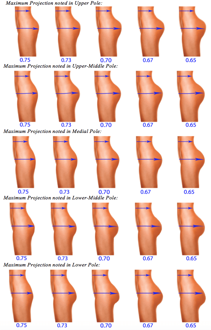 Brazilian Butt Lift Statistics