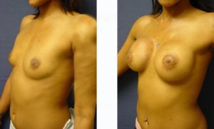 breast augmentation surgery result - left lateral view