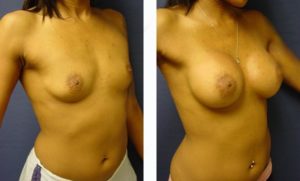 breast augmentation surgery result - right lateral view